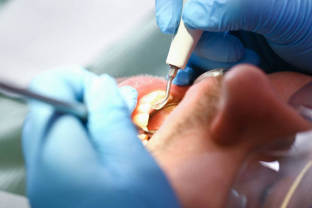 Best Emergency Root Canal Treatment in Logan, UT