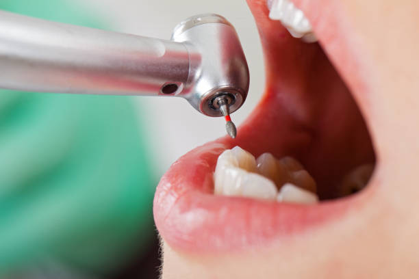 Best Emergency Root Canal Treatment in Logan, UT